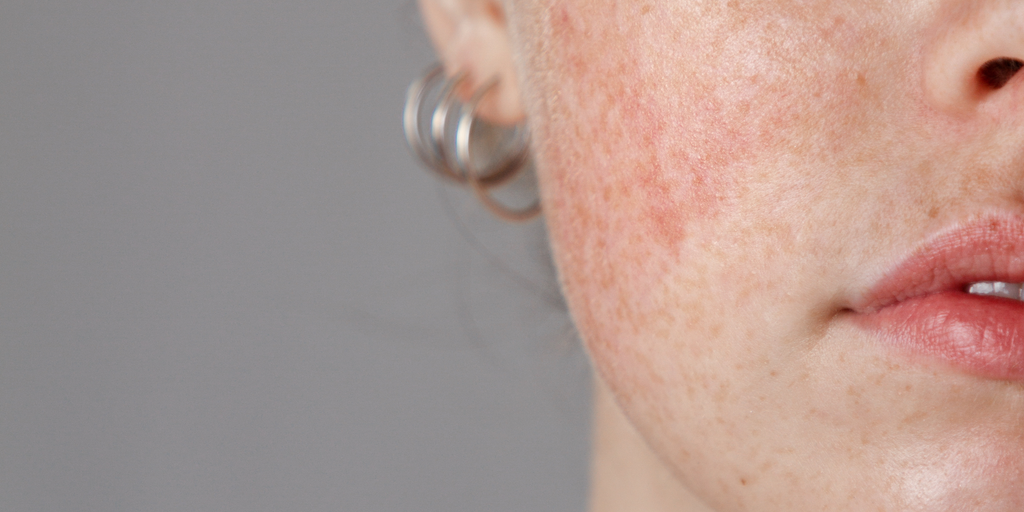 Unlocking the Mysteries of Rosacea: Understanding and Managing Flare-Ups